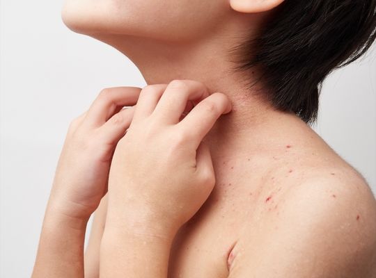 腸活　アトピー　アトピー性皮膚炎　乳児湿疹